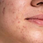 Proven Acne Mapping: Nutritionist Reveals How to Transform Your Skin