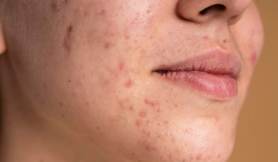 Proven Acne Mapping: Nutritionist Reveals How to Transform Your Skin