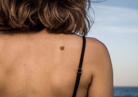 Study Reveals Alarming COVID-19 Impact on Melanoma Incidence Trends