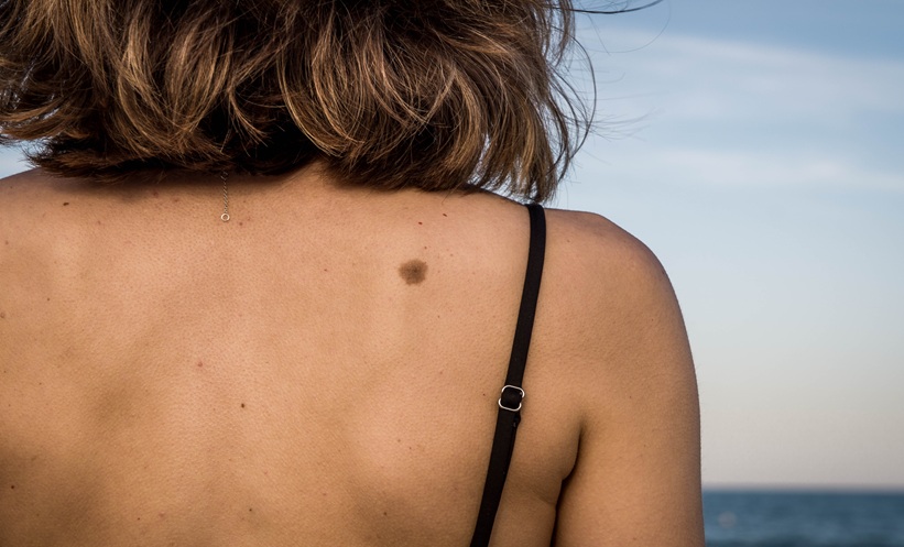 Study Reveals Alarming COVID-19 Impact on Melanoma Incidence Trends