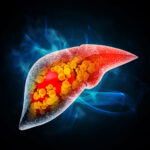 What Drives Mortality in MASLD? Key Risk Factors Revealed