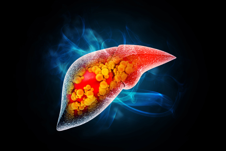 What Drives Mortality in MASLD? Key Risk Factors Revealed